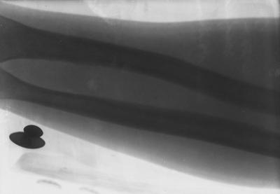 An X - Ray on 26x seed plate of Dr. Davis' arm.  The X - Ray was most likely taken by Dr. Pryor