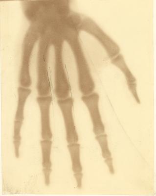 Probably for Dr. Pryor by Nollau- hand x-ray