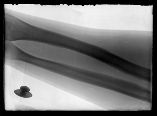 X-ray on 26x seed plate; Dr. Davis' arm