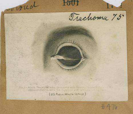 Eye infected with trachoma