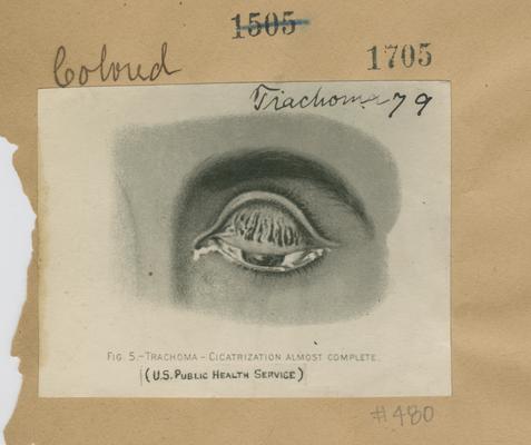 Eye infected with trachoma