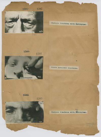 Patient with chronic trachoma with ectropion