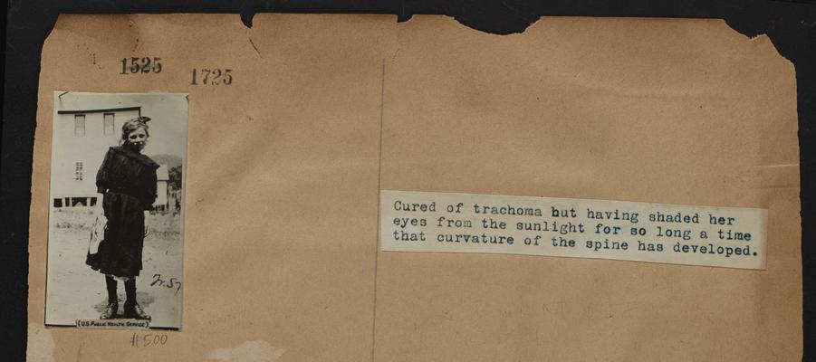 Cured of trachoma but having shaded her eyes from the sunlight for so long a time that curvature of the spine has developed