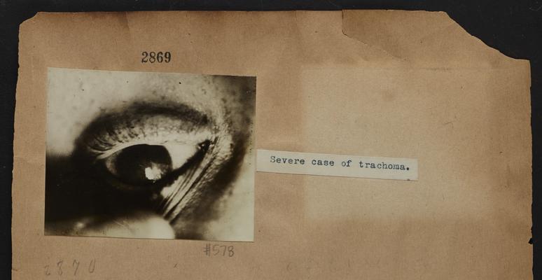 Eye with a severe case of trachoma