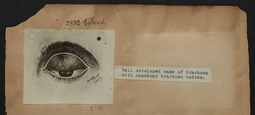 Drawing of an eye with well developed case of trachoma with abundant trachoma bodies