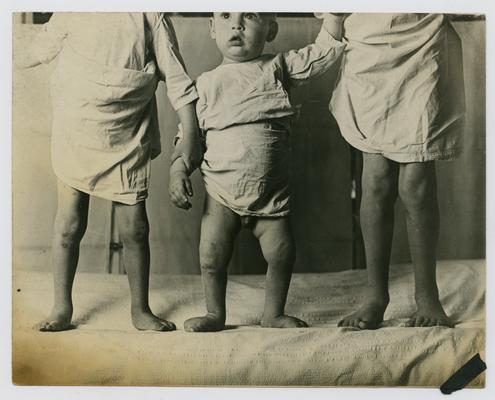 Patients, group, unknown- The child in the middle-- a crippled child in Linda Neville's care