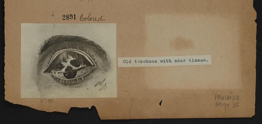 Drawing of an eye with old trachoma with scar tissue