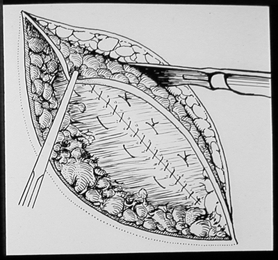 Suturing techniques labeled 